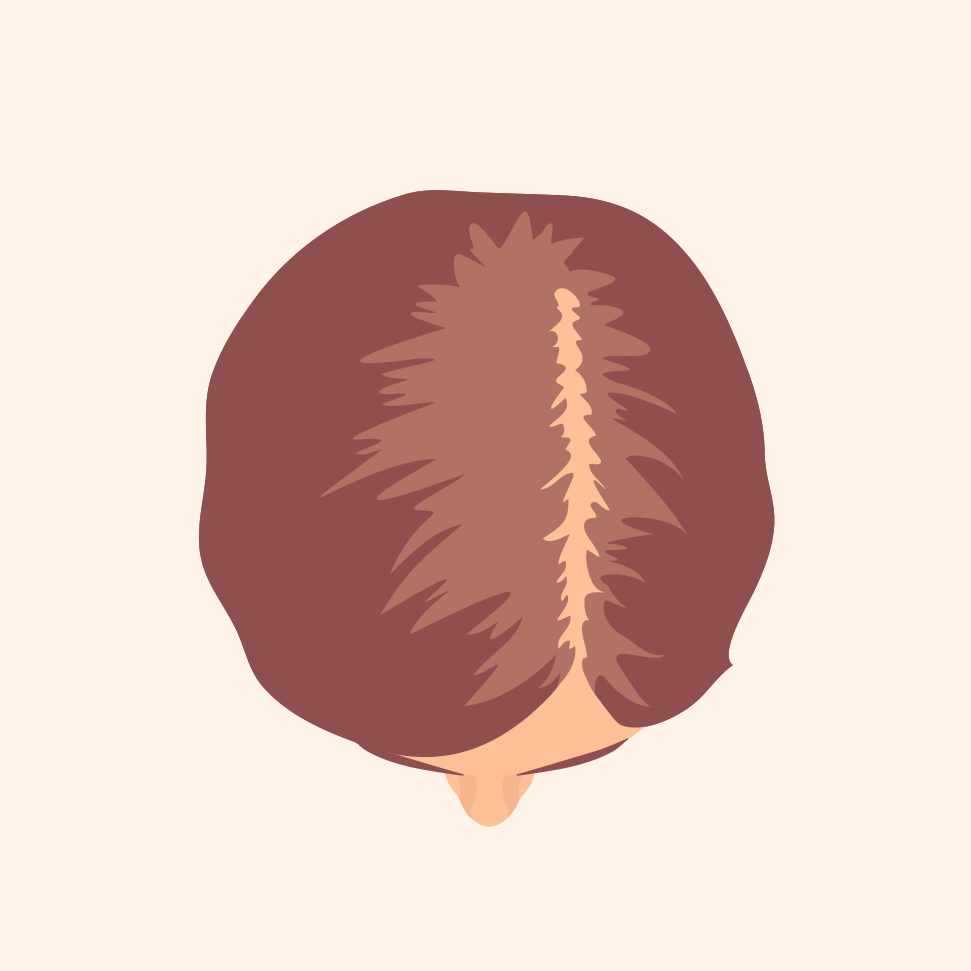 Stage 1