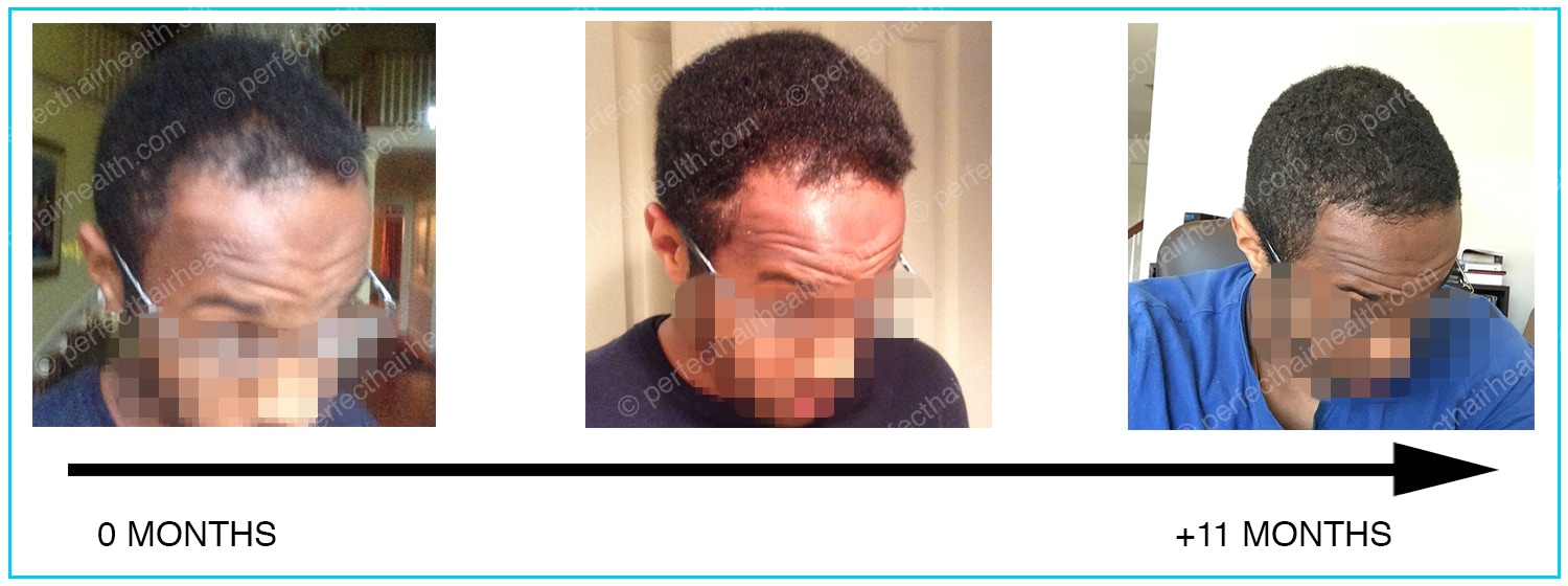 How Vitamin D Deficiencies Can Cause Hair Loss See Photos in Vitamin D For Hair Loss