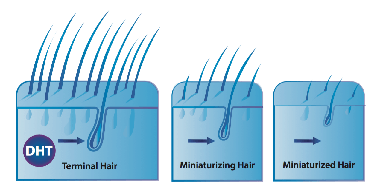 Natural DHT Blockers vs Finasteride They All Cause Sexual Side