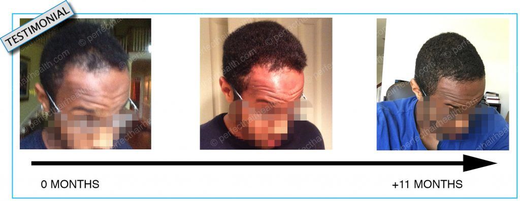 Natural hairline regrowth