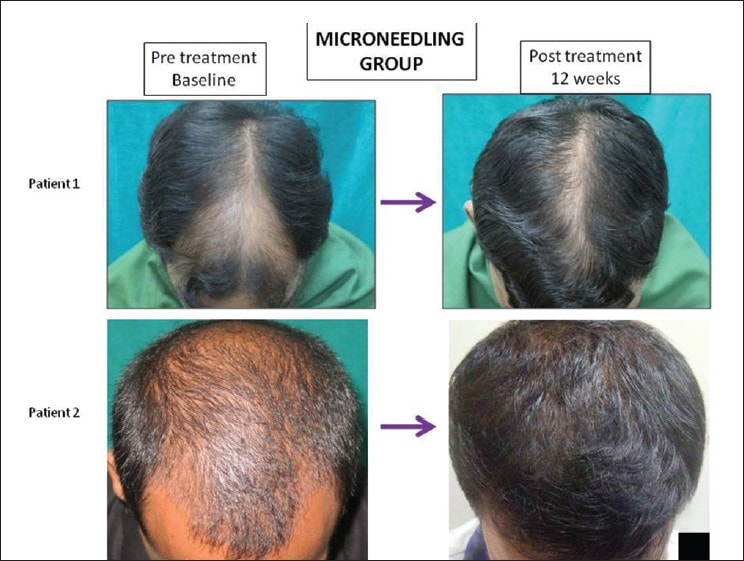 rogaine results timeline