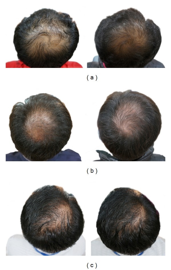 Standardization of Amarantha hair oil with special reference to  identification of βsitosterol as major component having 5αreductase  inhibitory activityhair growth promoting activity  Semantic Scholar