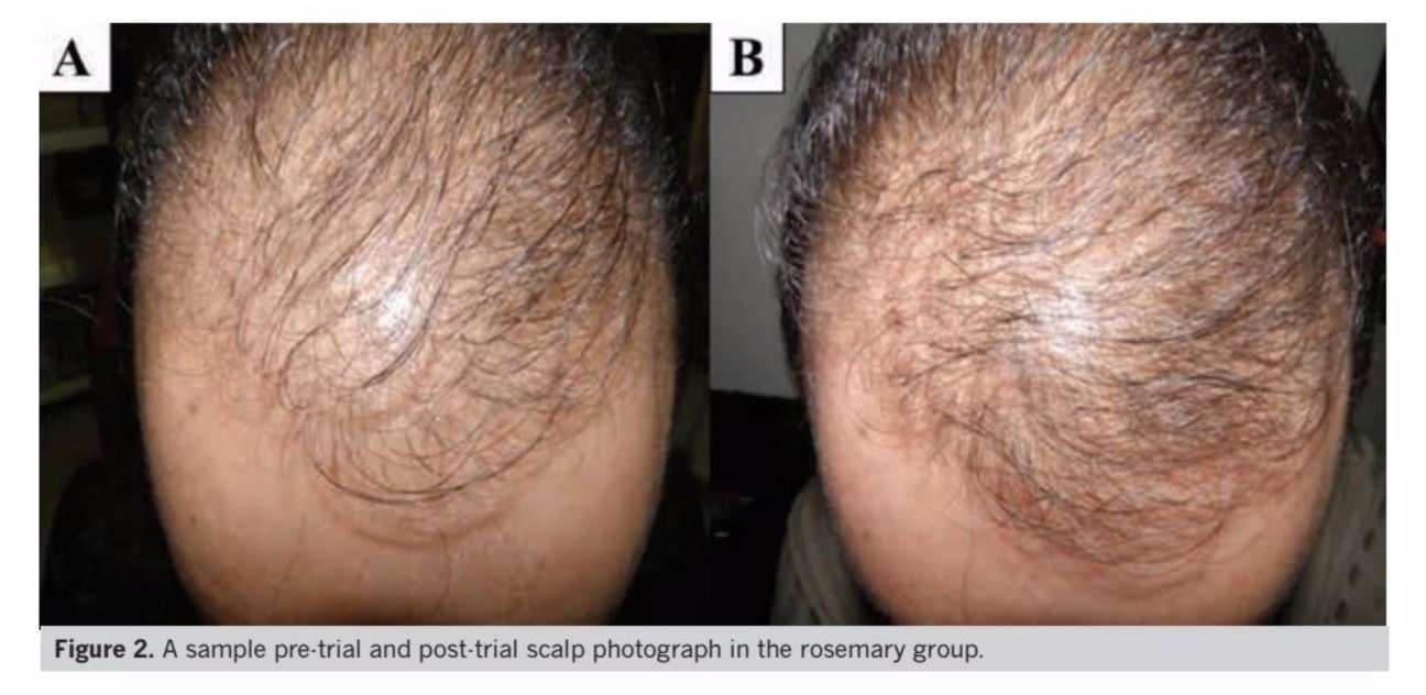 Rosemary Oil For Hair Loss Not So Fast See Photos Evidence