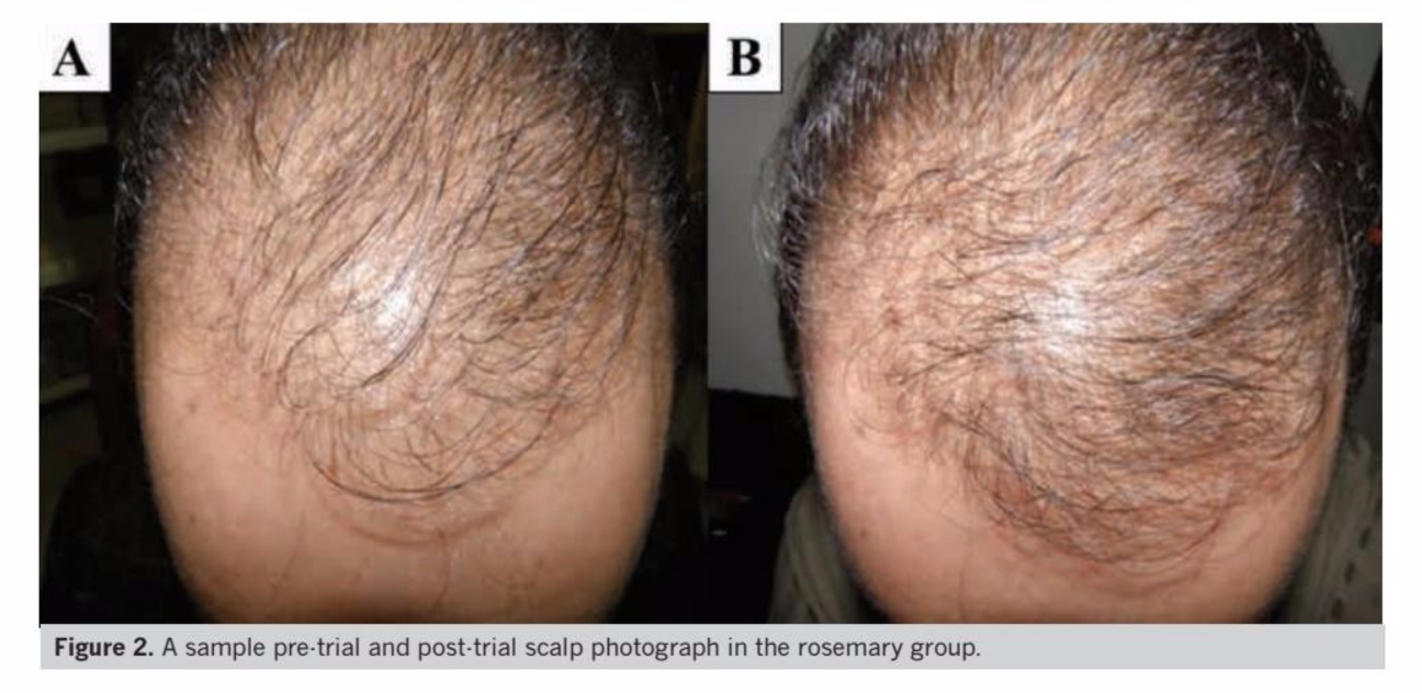 Rosemary Oil Before After Photo Hair Growth 