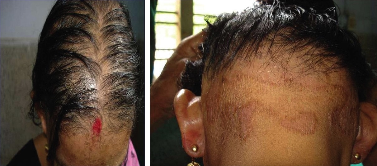 Zinc For Hair Loss Why This Mineral Matters See Photos