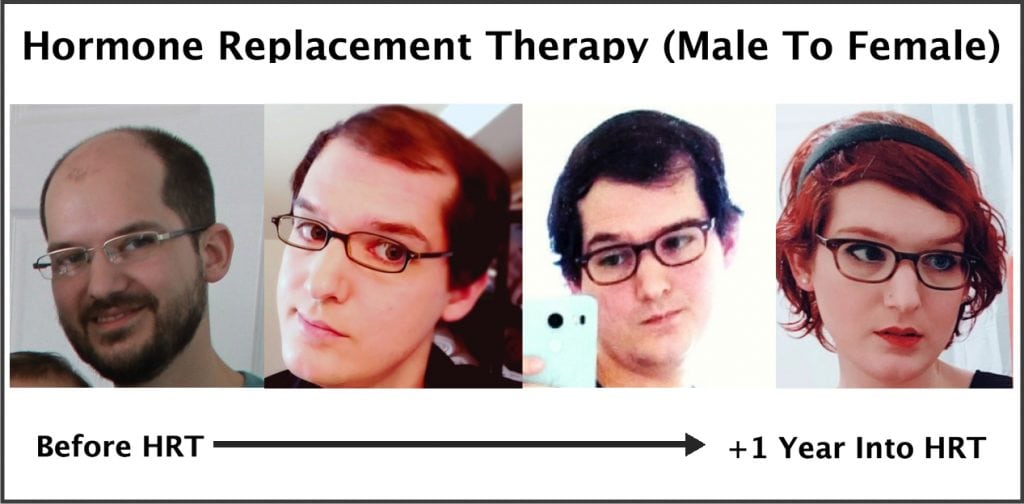 Exactly How Trans Hormone Replacement Therapy Regrows Hair (Photos)