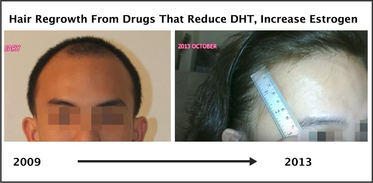 Exactly How Trans Hormone Replacement Therapy Regrows Hair Photos