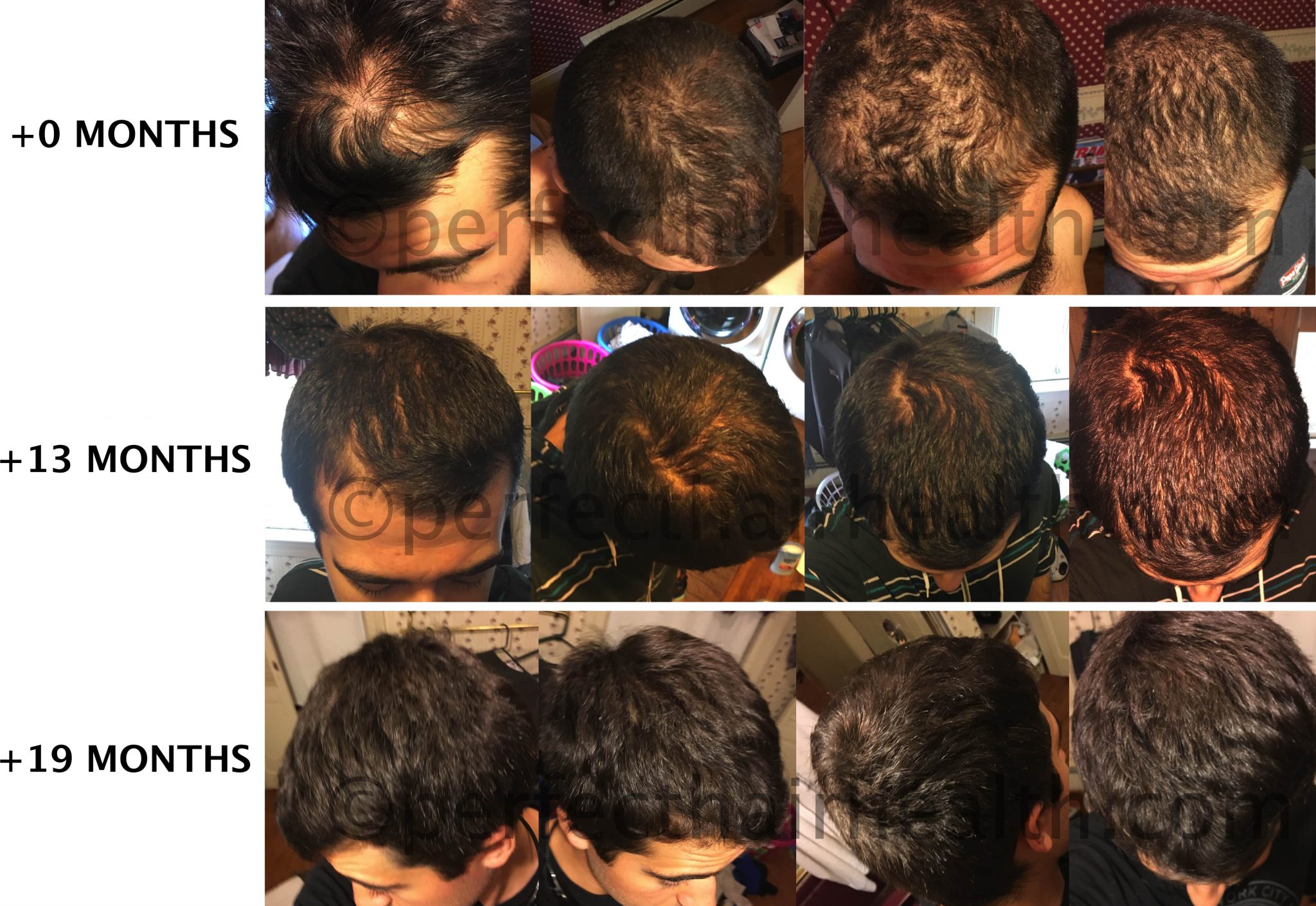 Do Scalp Massages Improve Hair Loss (AGA)? Our 2019 Study Results