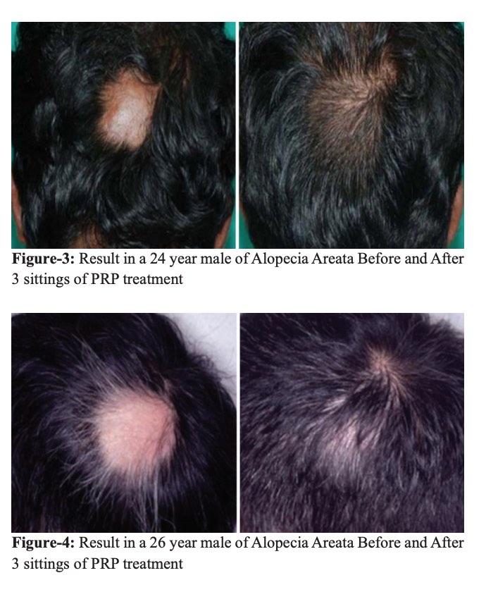 PlateletRich Plasma (PRP) For Hair Loss Does It Work