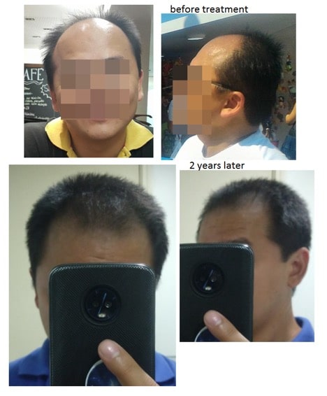 How Often To Microneedle For Hair Loss It Depends Studies Photos