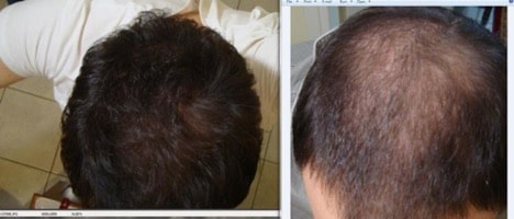 Microneedling Weekly Hair Regrowth