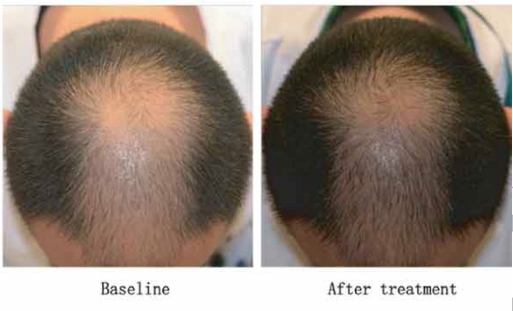 Microneedling For Hair Loss What S The Best Needle Length It Depends