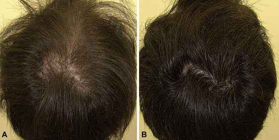 2 months minoxidil results