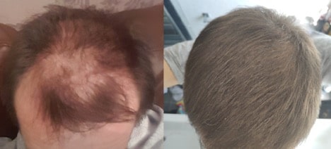 Reddit Microneedling Hair Growth