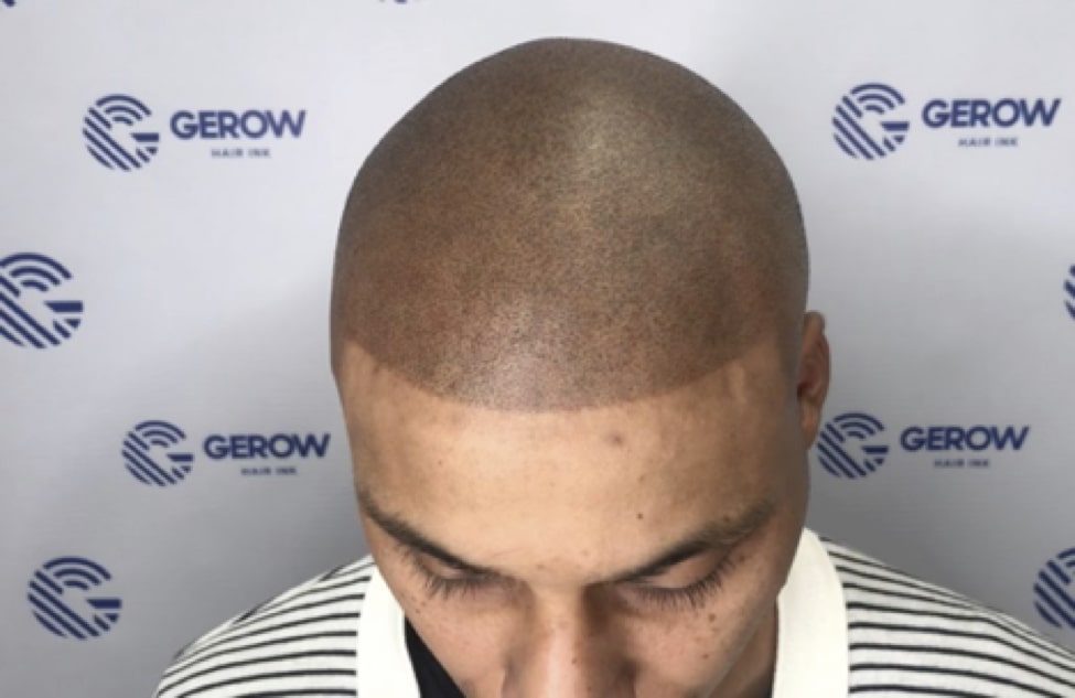 Scalp Micropigmentation – Bad Hairline