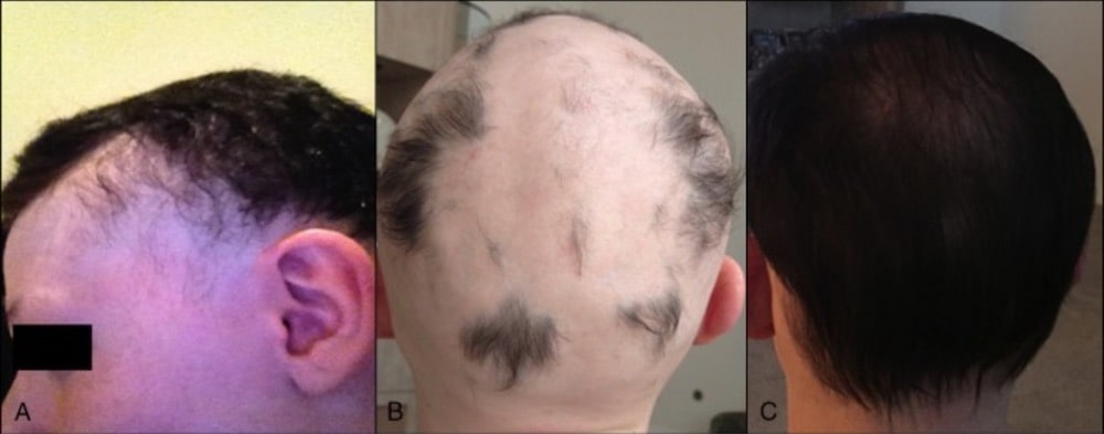 alopecia universalis regrowth signs