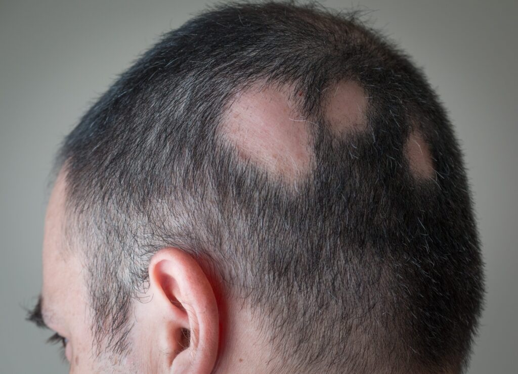 Helminth Therapy for Hair Loss