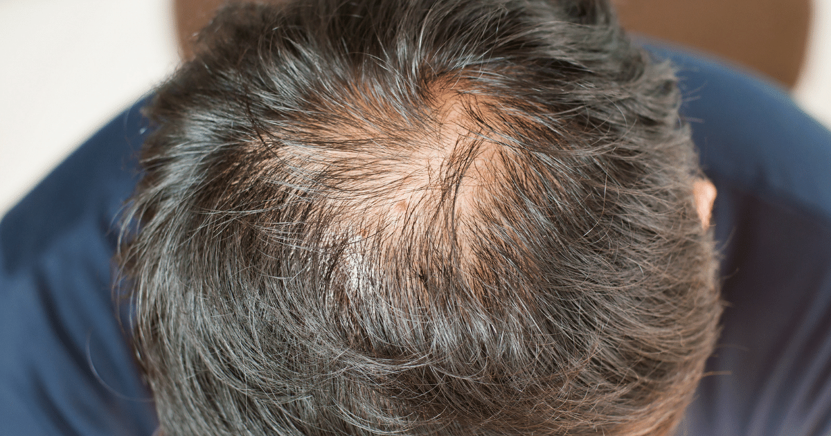 How Long Stopping Minoxidil Before Lose Our Hair Gains? - Perfect Health