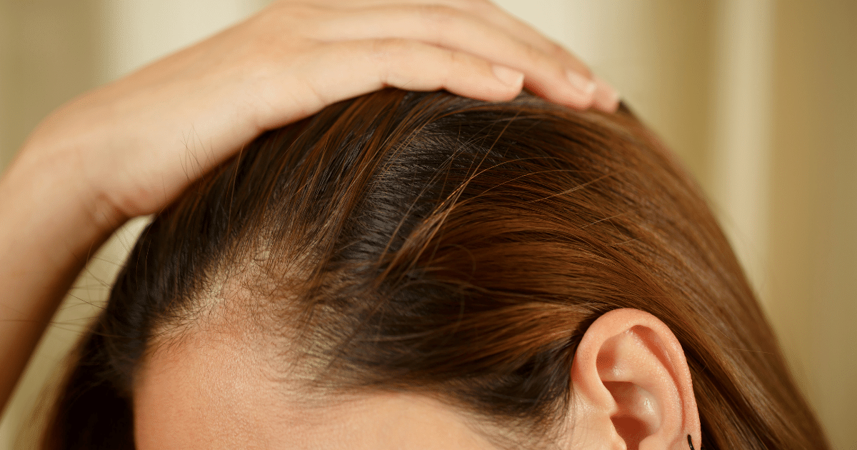 Photo of a woman with hair loss