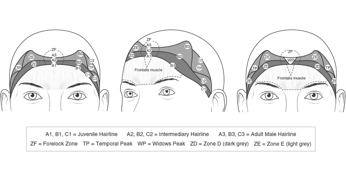 normal hairline vs receding