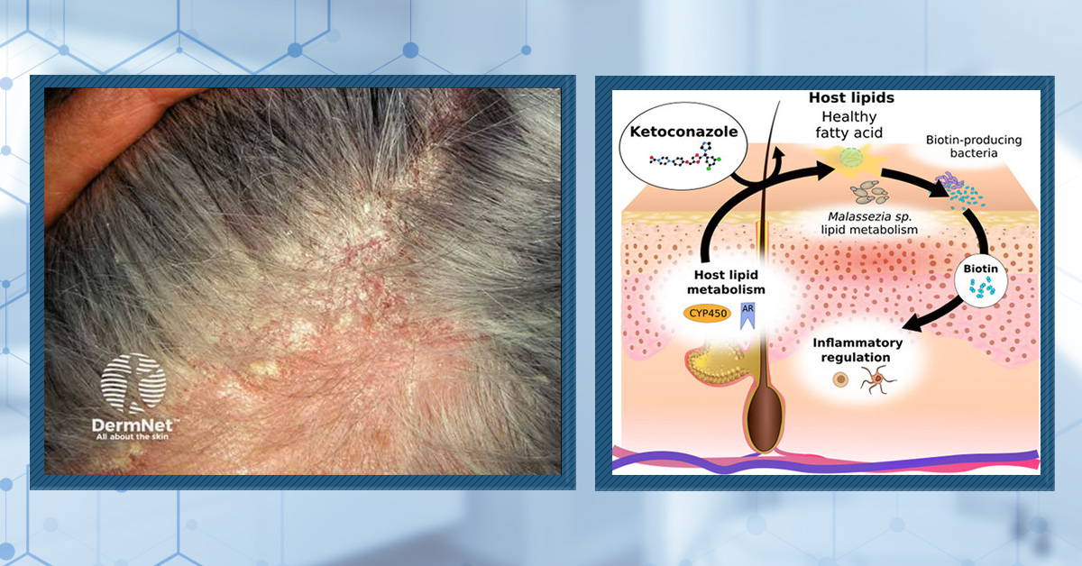 Seborrheic Dermatitis: Symptoms, Treatments, & Its Impact On Hair Loss