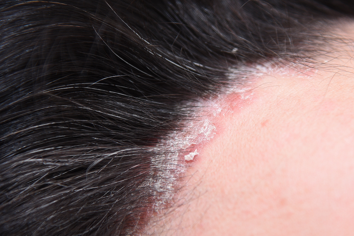 Scalp Psoriasis: Symptoms, Causes, and Effects on Hair Loss