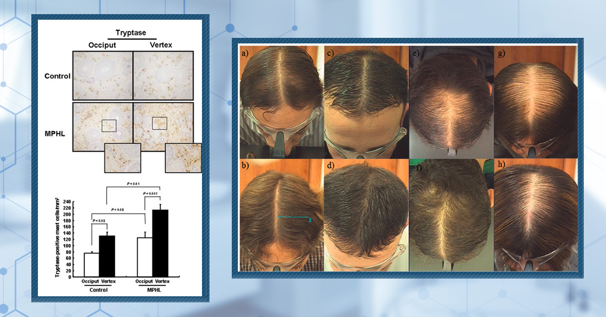 Topical Cetirizine: An Anti-Histamine That Regrows Hair? (New Evidence)
