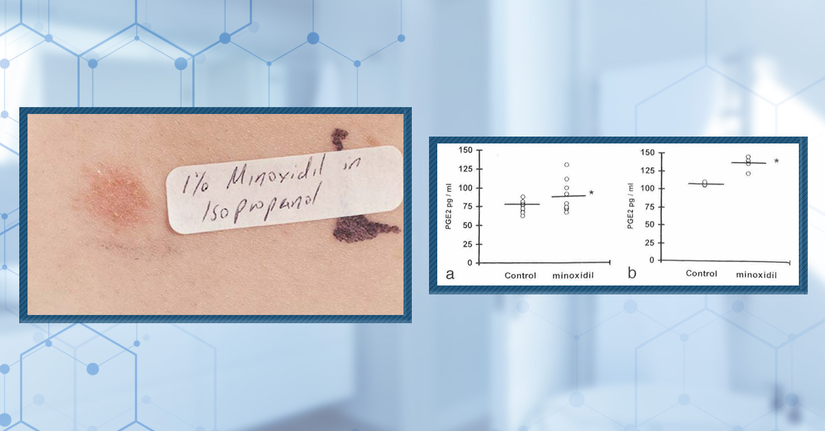 Does Minoxidil Cause Skin Aging?