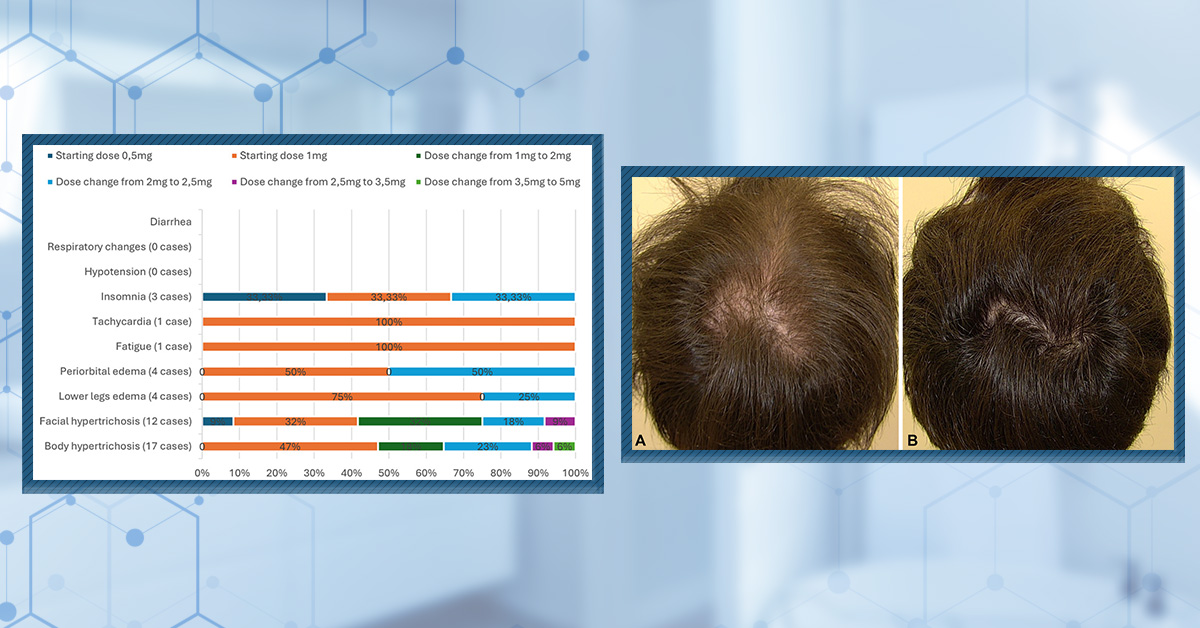 Oral Minoxidil – Ultimate Guide
