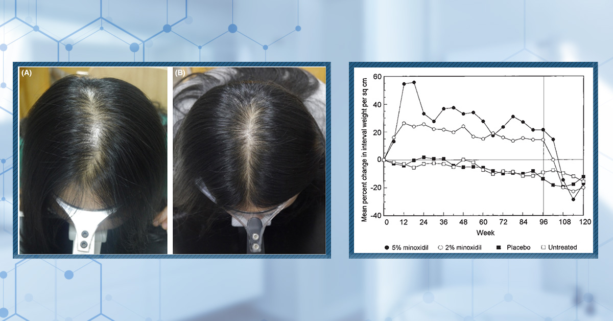 Topical Minoxidil for Hair Growth: Efficacy, Safety, and How to Enhance Results