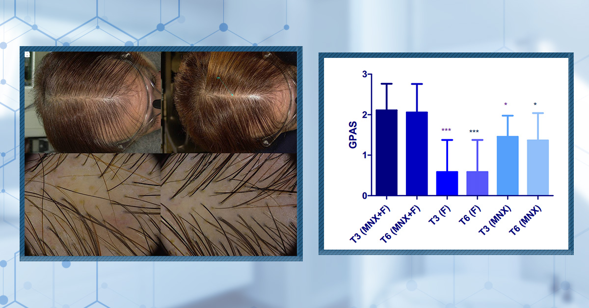 Does Topical Finasteride Work?