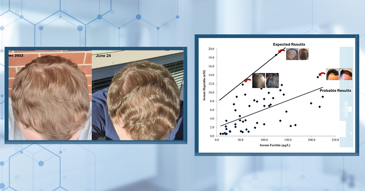 Dutasteride Before and After: 10 Success Stories
