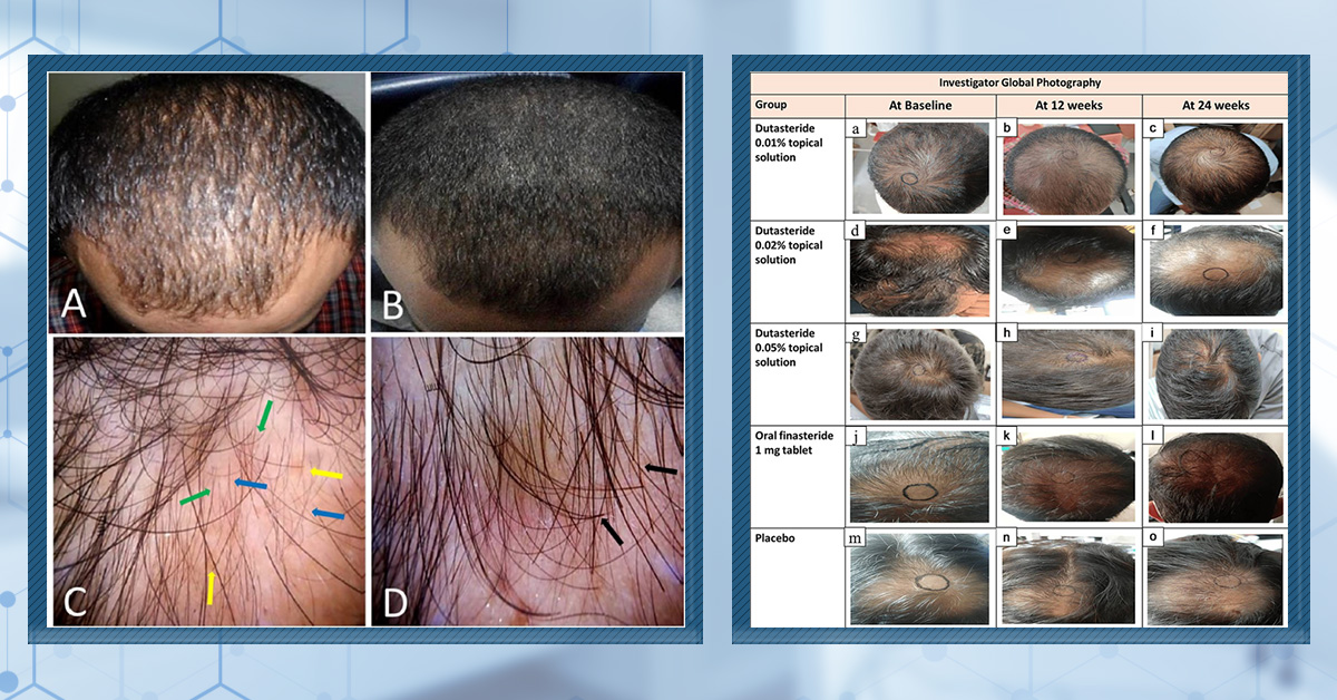 Does Topical Dutasteride Work?