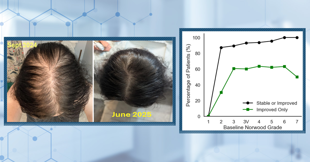 Oral Minoxidil: Before and After Photos [2025]