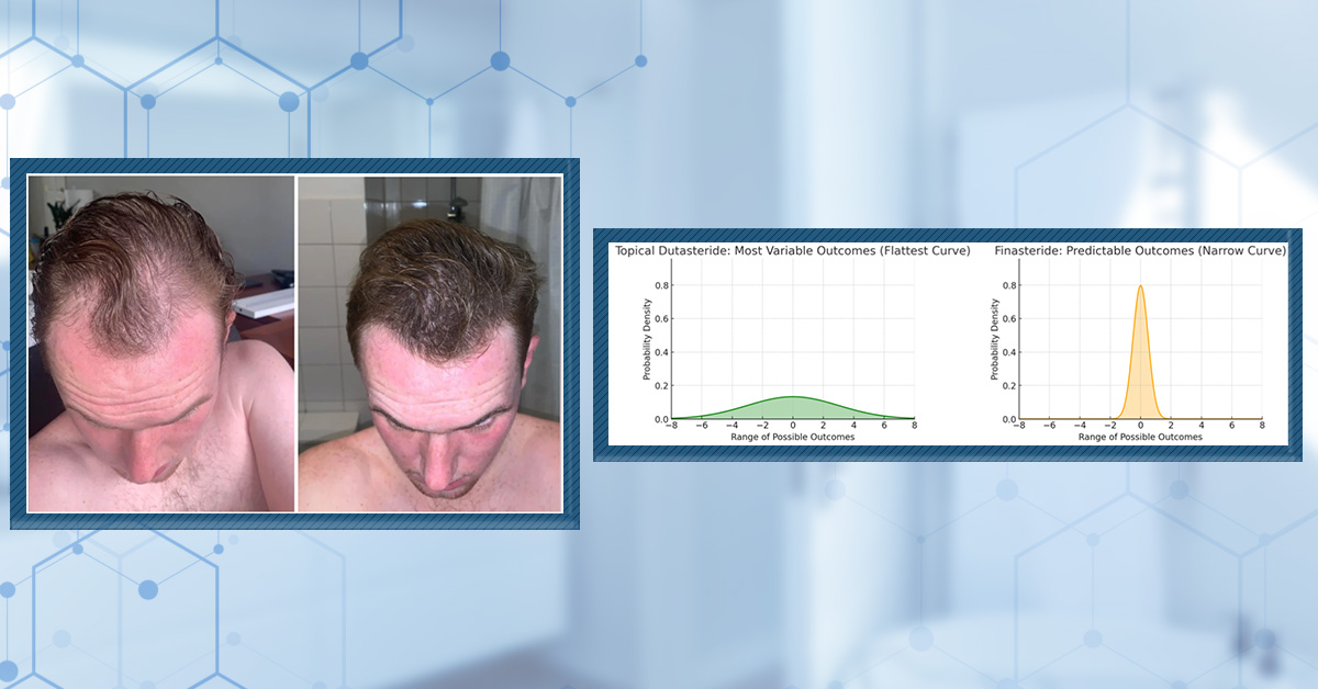 Topical Finasteride Before and After: Real Case Studies