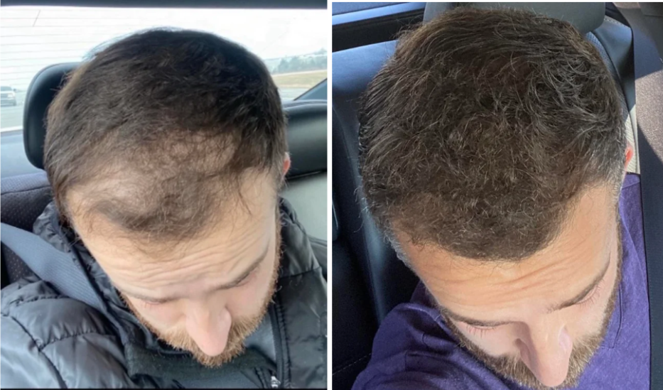 Oral Minoxidil Before And After Photos 2026 Oral Minoxidil Before And After Photos 2026