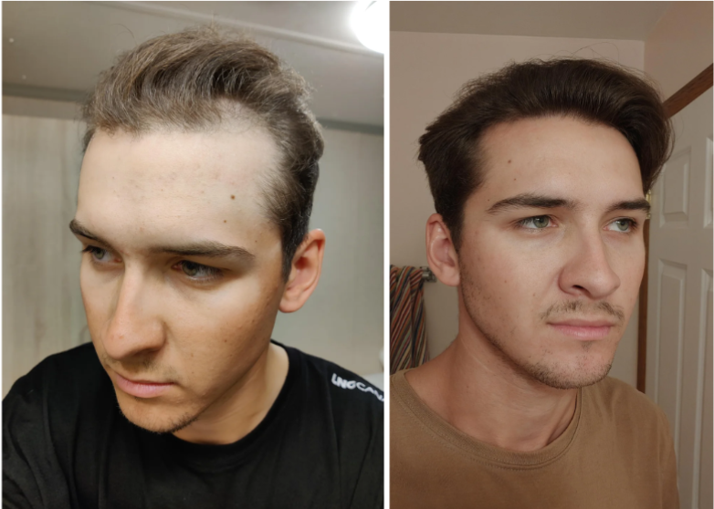Oral Minoxidil Before And After Photos 2026 Oral Minoxidil Before And After Photos 2026