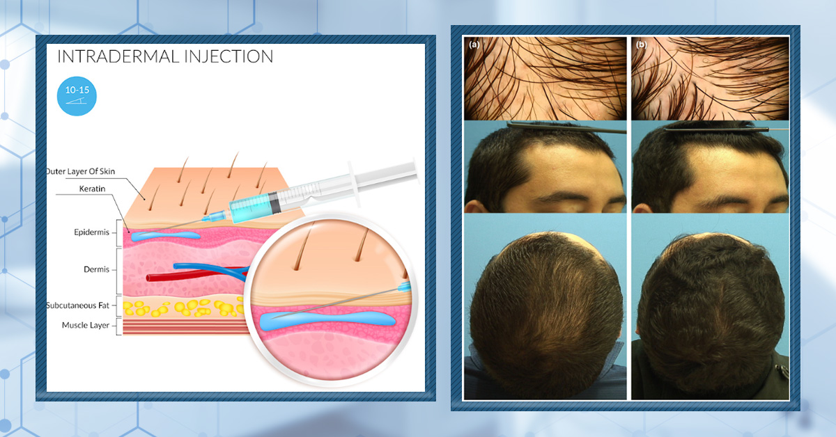 Topical & Mesotherapy Dutasteride for Hair Loss: Evidence, Dosing, Safety