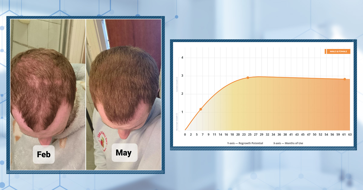 Oral Finasteride Before and After: Real Case Studies