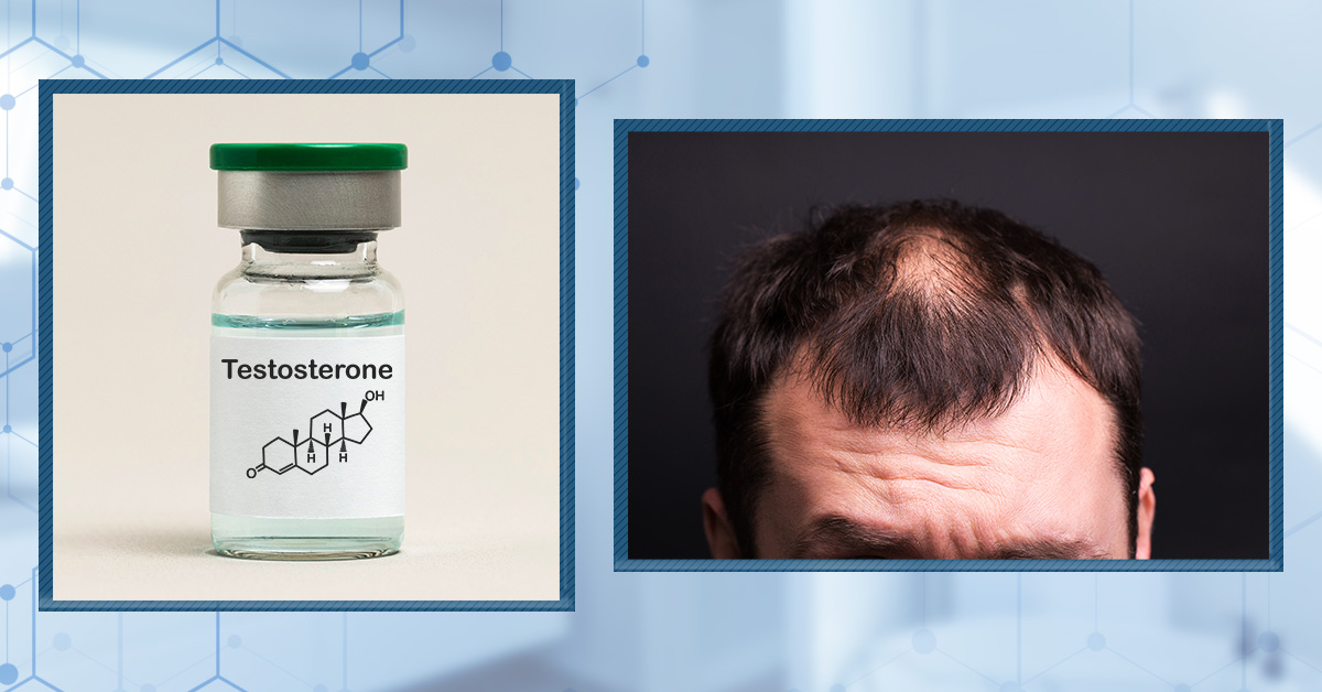 5 Ways to Prevent Hair Loss While Taking Testosterone
