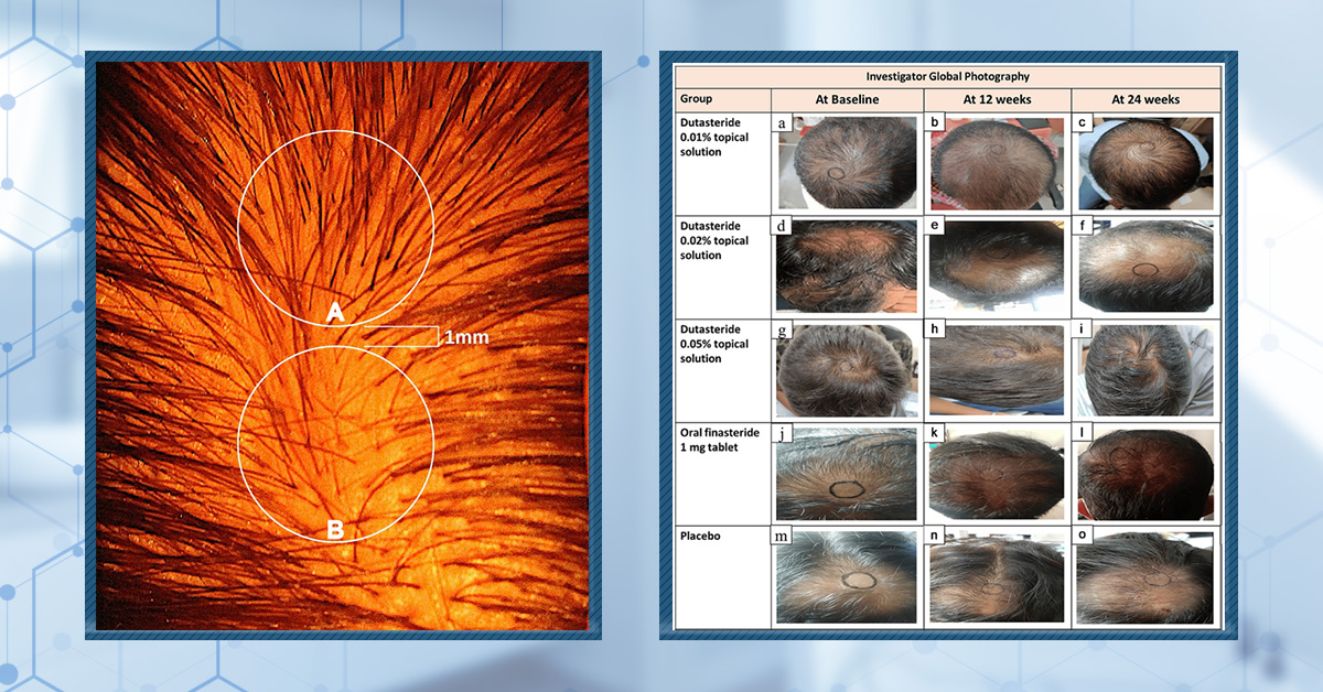 Low-Dose Topical Dutasteride: Better Than Oral Finasteride? (New Study & Photos)