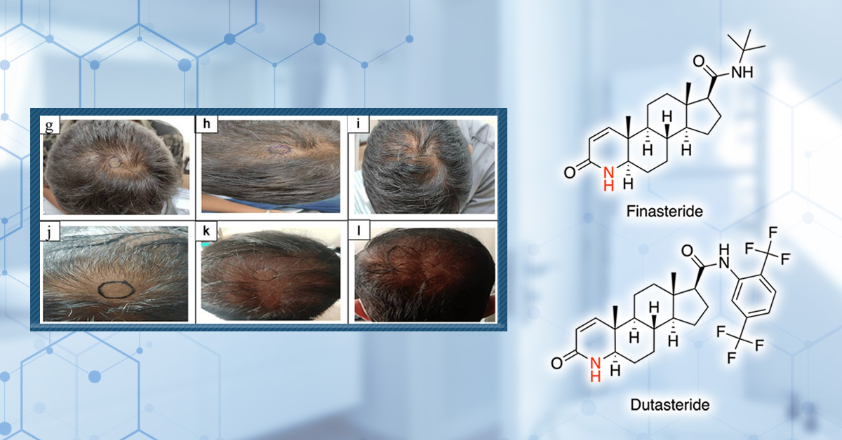 Switching From Finasteride to Dutasteride