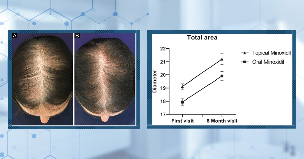 Oral vs. Topical Minoxidil: What’s Better for Hair Loss?