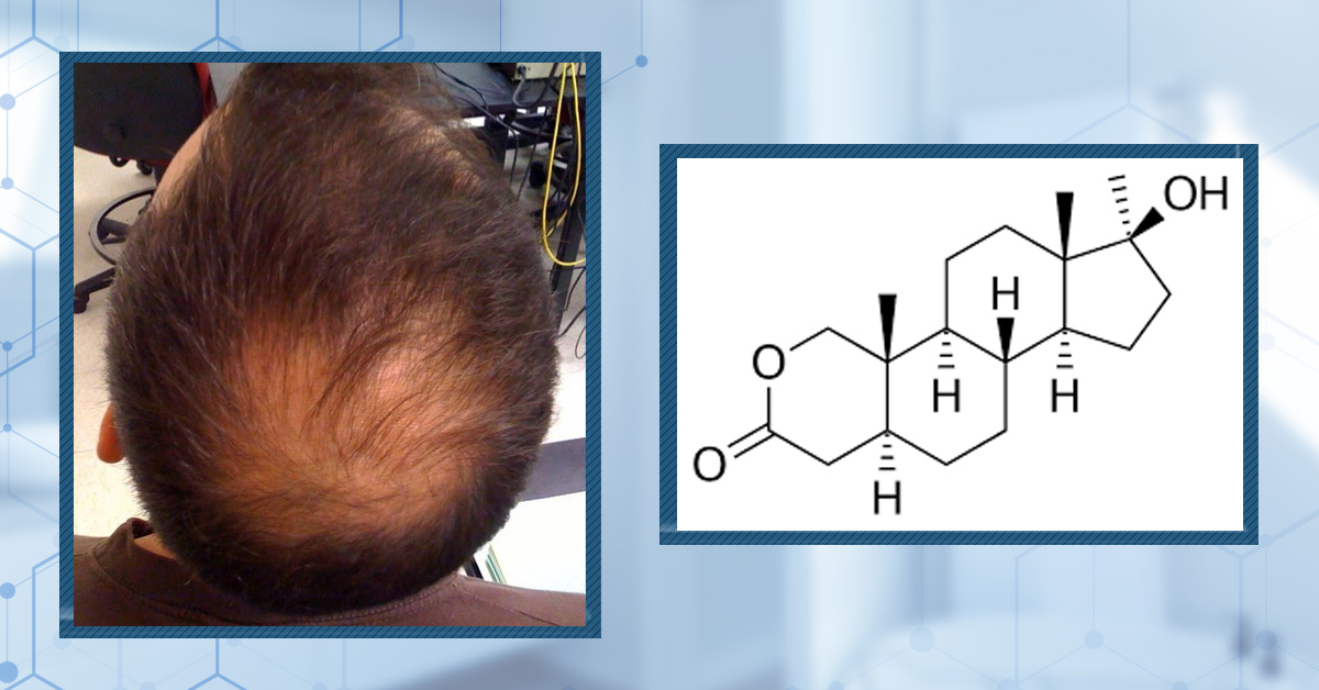 Does Anavar Cause Hair Loss?