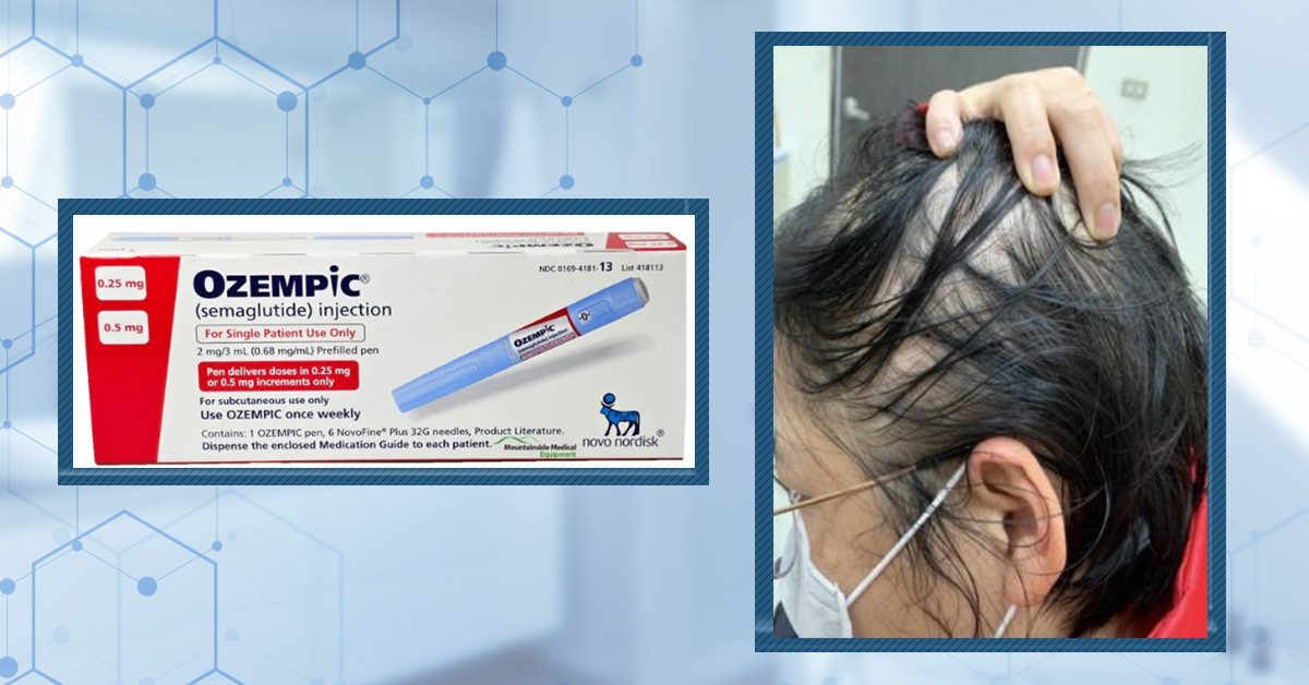 semaglutide and hair loss Does Semaglutide Cause Hair Loss