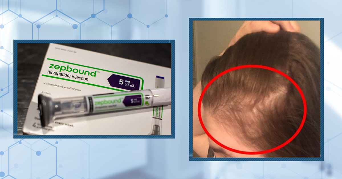 does tirzepatide cause hair loss Does Zepbound Cause Hair Loss?