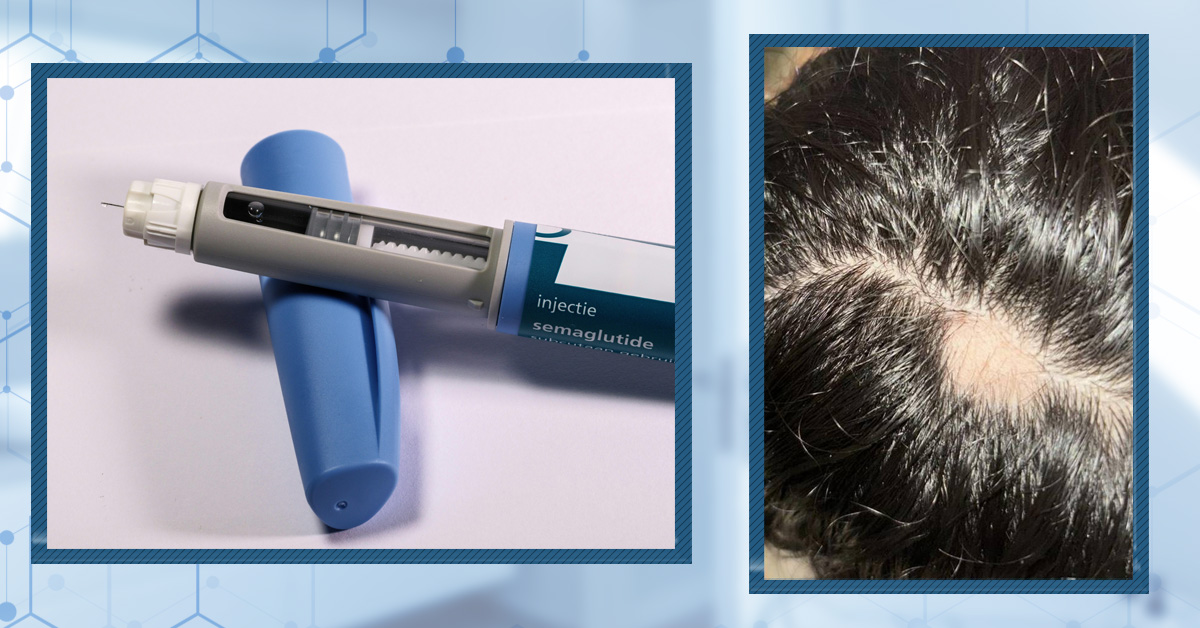 Does Ozempic Cause Hair Loss?