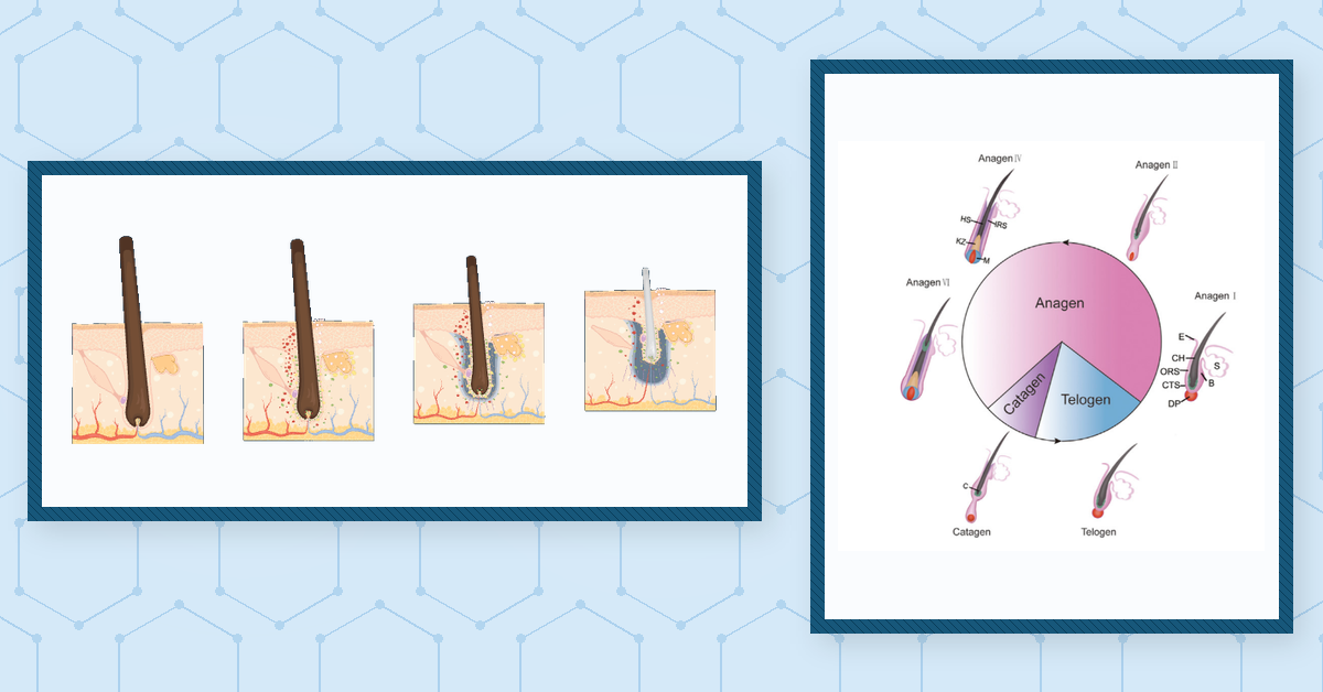 Can Miniaturized Hair Follicles Recover, or Is There a Point of No Return?